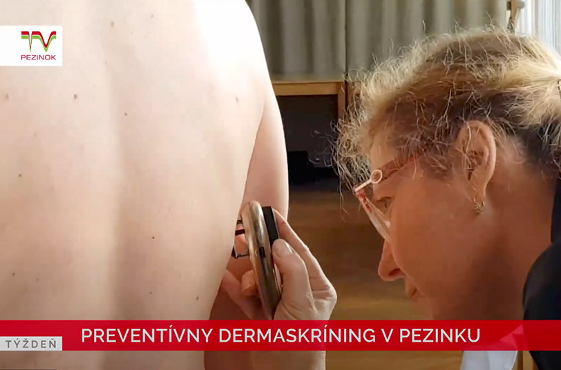 Preventívny dermaskríning v Pezinku